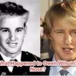 owen wilson nose