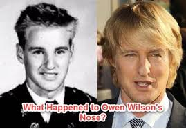 owen wilson nose